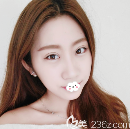 來看廣州海峽閆倫全切雙眼皮案例15天恢復(fù)過程圖 來看廣州海峽閆倫全切雙眼皮案例15天恢復(fù)過程圖