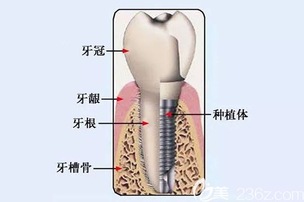 北京圣貝口腔德國種植牙價格 北京圣貝口腔德國種植牙價格
