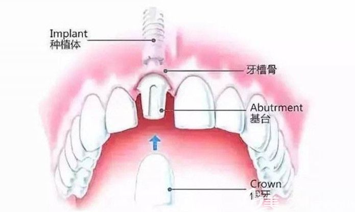 牙齒種植修復(fù)過程 牙齒種植修復(fù)過程