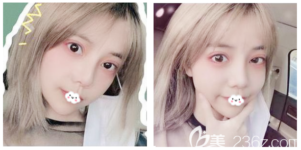 做完埋線雙眼皮修復兩個月了就問你們美不美？我自己感覺修復得很成功哦