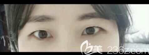 面診醫(yī)生術(shù)前單眼皮狀態(tài) 面診醫(yī)生術(shù)前單眼皮狀態(tài)