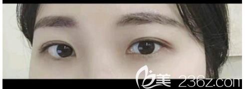 閨蜜做的埋線雙眼皮不到一年線就開了，為避免失敗我直接做了切開雙眼皮