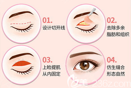 深圳yestar藝星整形謝文文雙眼皮手術(shù)過(guò)程圖