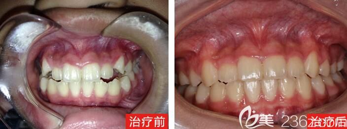隱適美牙套戴了700多天終于摘掉啦!我的矯正虎牙過程有點不容易呀