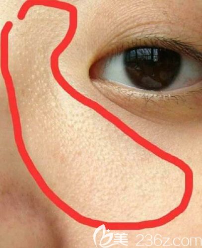 眼周長出來的顆粒 眼周長出來的顆粒