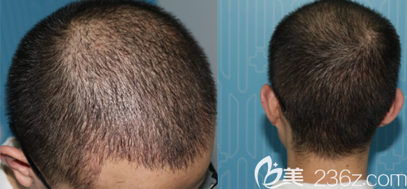 發(fā)際線后退的IT男是怎么確定在這植發(fā)3000單位就能讓自己的恢復(fù)原貌的?