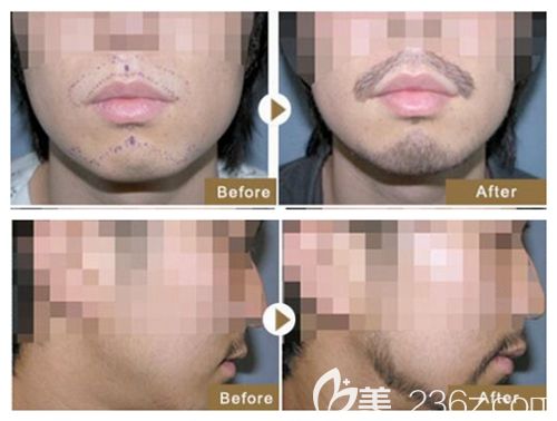 別怕!男人丟掉的“面子”可以通過胡須種植重新撿回來