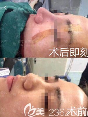 及愛聽隆鼻手術(shù)術(shù)后即刻 及愛聽隆鼻手術(shù)術(shù)后即刻