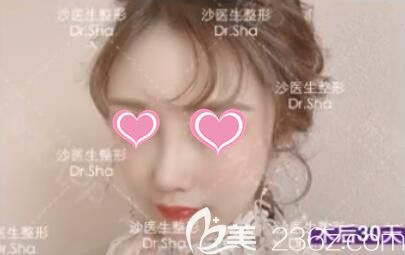 做肋骨鼻綜合+全面部脂肪填充術(shù)后一個月的效果，大家覺得怎么樣？