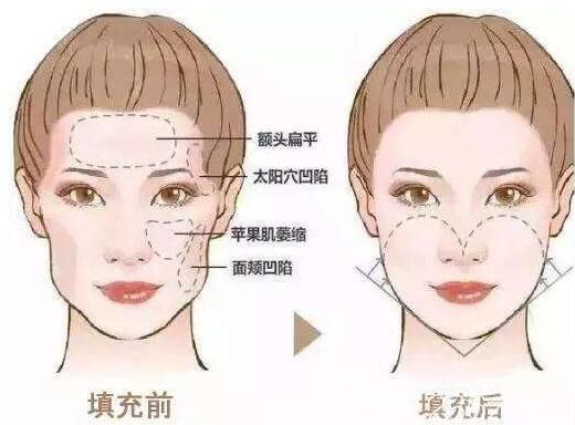 自體脂肪填充可以修飾改善臉型 自體脂肪填充可以修飾改善臉型