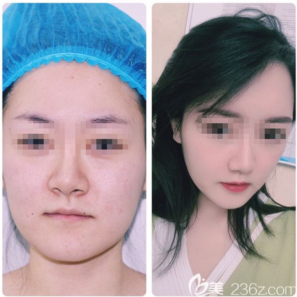 從術(shù)前到做完脂肪填充術(shù)后三個月對比 從術(shù)前到做完脂肪填充術(shù)后三個月對比