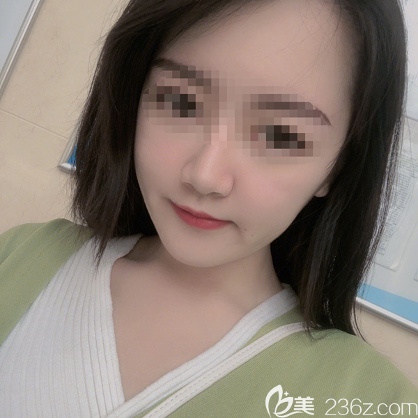 笑話我臉大還去做脂肪填充，看完術(shù)后三個(gè)月效果，她也偷偷去填充了160ml