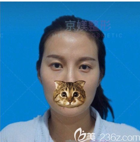 面部脂肪填充術前太陽穴和臉頰凹陷厲害 面部脂肪填充術前太陽穴和臉頰凹陷厲害