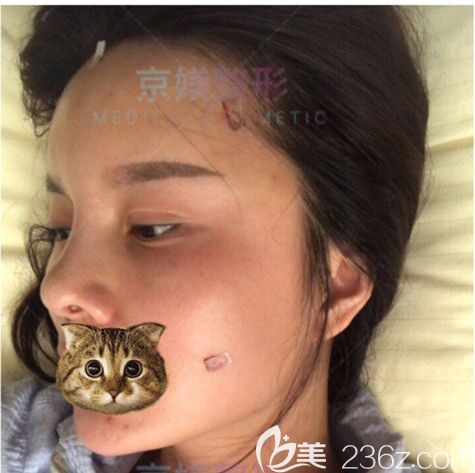 剛做完脂肪填充術后面部微腫 剛做完脂肪填充術后面部微腫