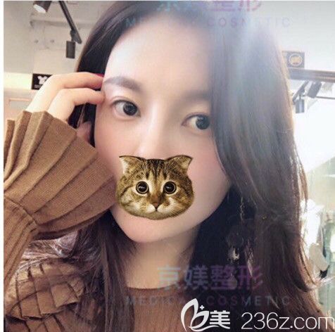 脂肪填充面部術后20天基本恢復 脂肪填充面部術后20天基本恢復