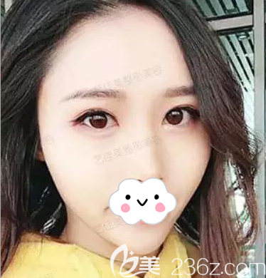 對(duì)我這樣太陽(yáng)穴凹陷額頭不飽滿還想變美的人來(lái)說(shuō),做自體脂肪填充無(wú)疑比化妝更明智!