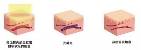 染料激光去紅血絲的原理 染料激光去紅血絲的原理