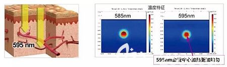 595染料激光要比585更有優(yōu)勢(shì) 595染料激光要比585更有優(yōu)勢(shì)
