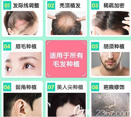 韓妃植發(fā)適用于所有毛發(fā)種植 韓妃植發(fā)適用于所有毛發(fā)種植