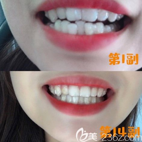 牙齒不齊矯正效果圖