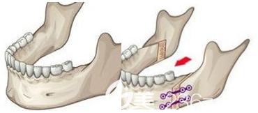 其實(shí)凸嘴除了靠做雙鄂手術(shù)可以解決之外還有很多方法