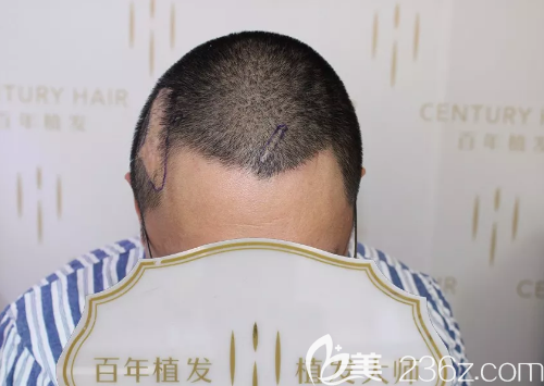 沈先生來院后醫(yī)生檢查了毛囊情況及疤痕部位的血運情況