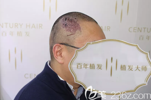 從出生陪伴他46年的胎記疤痕在使用UST-M技術植發(fā)1500單位后終于不見了