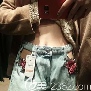 腰腹吸脂術(shù)后21天腫脹漸消