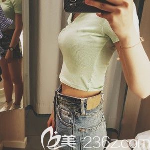 做吸脂瘦腰腹術(shù)后45天恢復(fù)效果