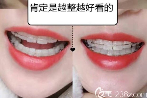 實(shí)力種草！自從我這一口大歪牙戴了1年多的陶瓷托槽半隱形牙套后效果可見
