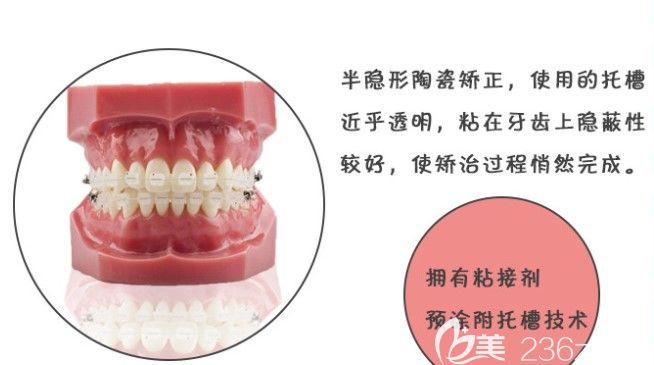 這個托槽好處還挺多的嘛