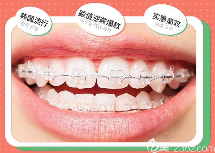 陶瓷半隱形托槽圖示