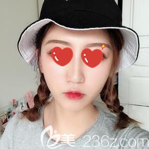 脂肪填充面部打卡記錄：術(shù)后70天到院復(fù)診醫(yī)生說(shuō)脂肪已經(jīng)成活50%左右