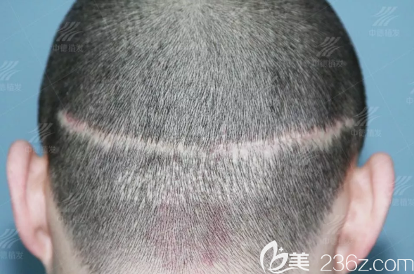 2次失敗的植發(fā)手術(shù)在后腦勺留下的疤痕 2次失敗的植發(fā)手術(shù)在后腦勺留下的疤痕
