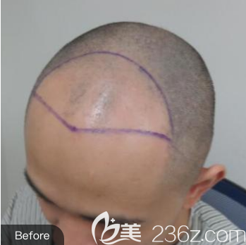 醫(yī)生給我畫出的種植區(qū) 醫(yī)生給我畫出的種植區(qū)