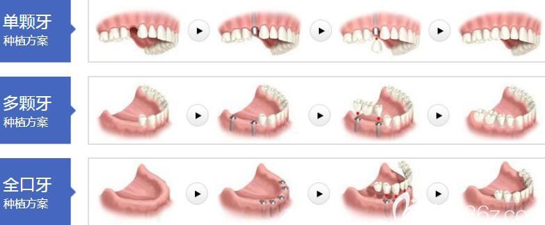 成都極光口腔林峰擅長項(xiàng)目