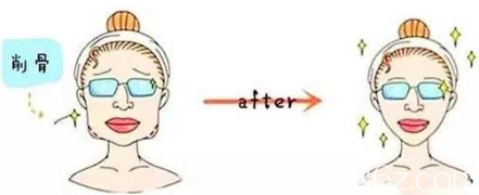 為什么有些人做完面部削骨手術(shù)之后會(huì)變老呢？