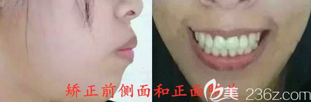 骨性齙牙矯正前照片 骨性齙牙矯正前照片