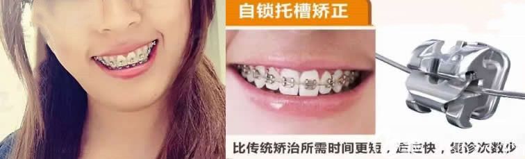 骨性齙牙在成都極光口腔戴自鎖金屬牙套 骨性齙牙在成都極光口腔戴自鎖金屬牙套