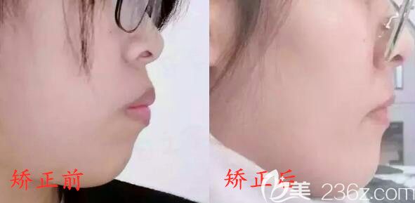 我是骨性嘴突,門牙做了烤瓷牙戴金屬自鎖矯正器后的側(cè)臉變化還挺大的哦！