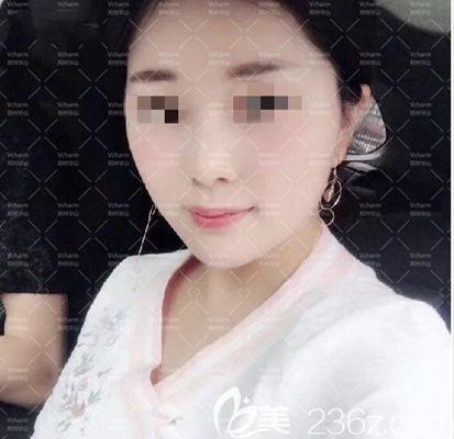 不私藏來分享我做的面部埋線提升手術(shù)后并沒有你們想象中老的那么快