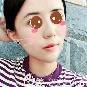 玻尿酸墊下巴術(shù)后即刻輕微腫脹