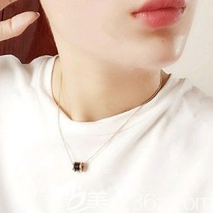 墊下巴術(shù)后12天基本恢復(fù)自然