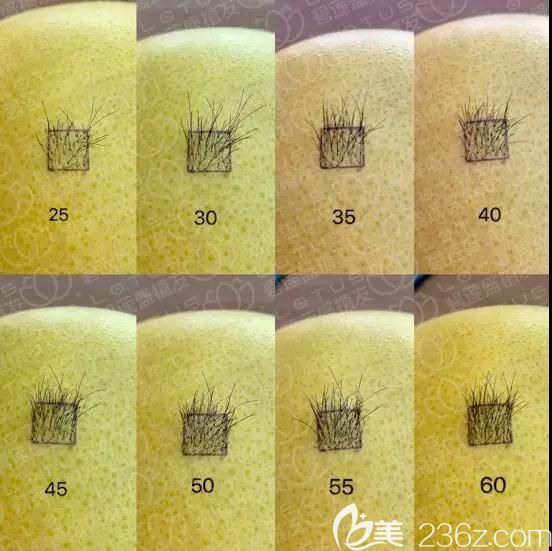 頭發(fā)種植密度示意圖