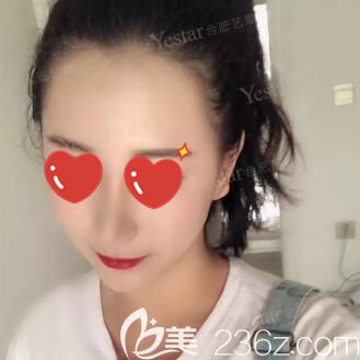 跟你們分享下駝峰鼻矯正后的親身經(jīng)歷，就知道這個手術到底有沒有風險了