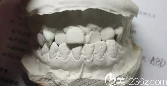 決定矯正后做的牙模