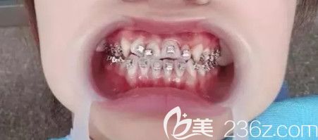 決定矯正時粘的托槽