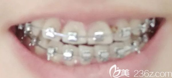 矯正三個月的效果圖