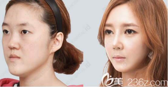 希望害怕做輪廓手術(shù)的妹子們可以通過我分享的經(jīng)歷得到一些勇氣 希望害怕做輪廓手術(shù)的妹子們可以通過我分享的經(jīng)歷得到一些勇氣