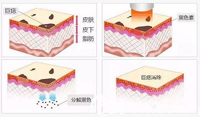 激光去痣的原理解析